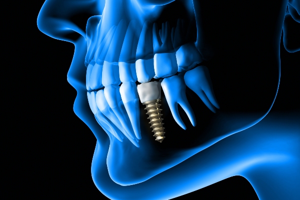 When Bone Grafting Is Needed For Dental Implants